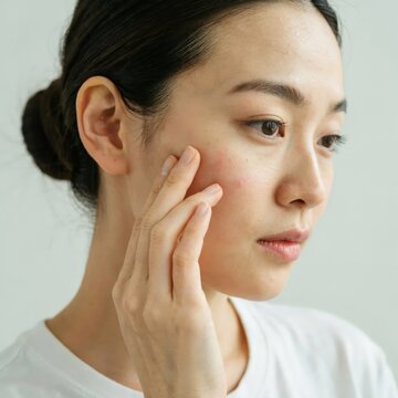 Young asian woman touching her cheek with skin irritation or acne, focusing on skincare and beauty routine