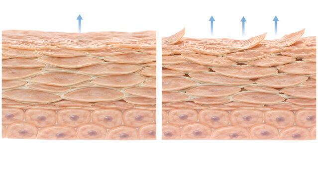 Intact and Dry Skin Barrier Comparison with Water Loss Arrows