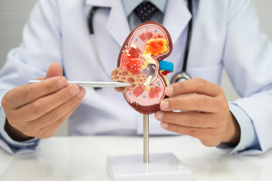 Chronic kidney disease, doctor with model for treatment urinary system, urology, Estimated glomerular filtration rate eGFR.