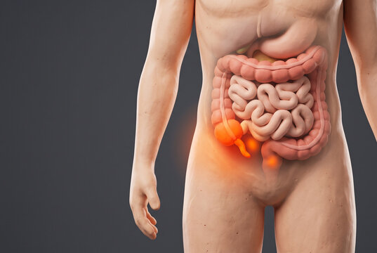 右下腹の盲腸と虫垂が赤く光る腹部の人体解剖3Dイラスト、虫垂炎や腹痛の症状を伝える医療イメージ