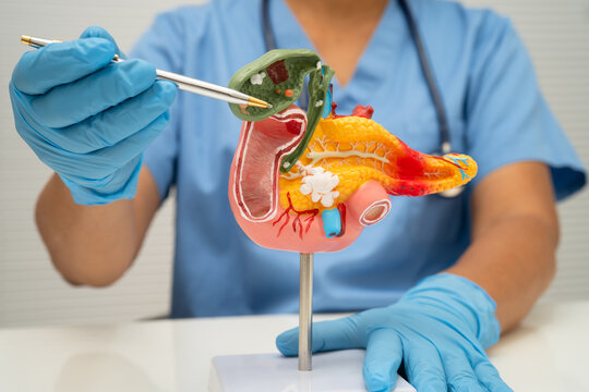 Pancreatitis, pancreatic cancer, Asian doctor with pancreas, gallbladder and bile duct human anatomy model at hospital.