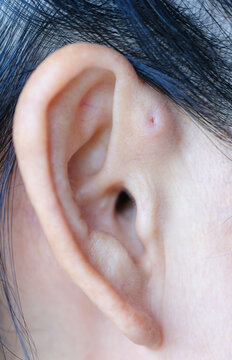 A preauricular sinus appears as a very small pit just in front of the external ear, these sinuses can drain a foul smelling discharge, and when this happens, they are prone to chronic infection.