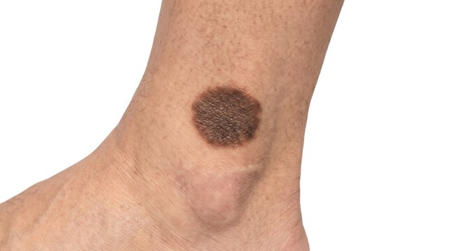 Isolated close-up of a large dark birthmark or congenital melanocytic nevus on an ankle