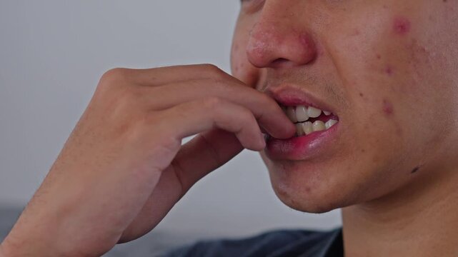 Young man biting nails anxiously, stress, and Attention Deficit Hyperactivity Disorder symptoms
