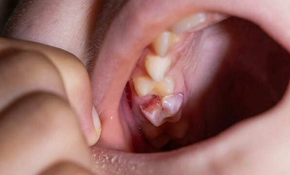 Close-up view of human mouth revealing severely broken molar tooth with noticeable defect and distinct red filling material visible, gums surrounding tooth exhibit signs of irritation