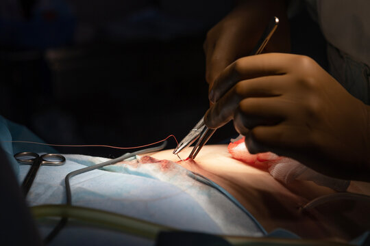Surgical intervention in the abdominal cavity through the navel. Laparoscopy in surgery. Surgeon's hands with medical instruments. A team of surgeons. Modern medicine. Laparoscopic instruments