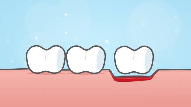 Missing Tooth Extraction Socket And Dental Implant Cartoon Animation