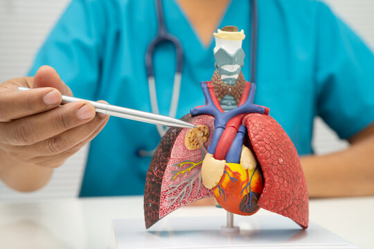 Pneumonia, lung cancer, Asian doctor holding human anatomy model for study diagnosis and treatment in hospital.