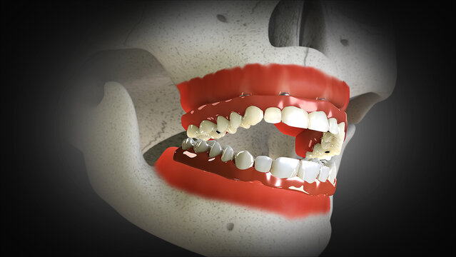 Mandibular and maxillary prosthesis with gum supported by 6 implants. 3D illustration of human teeth and dentures concept